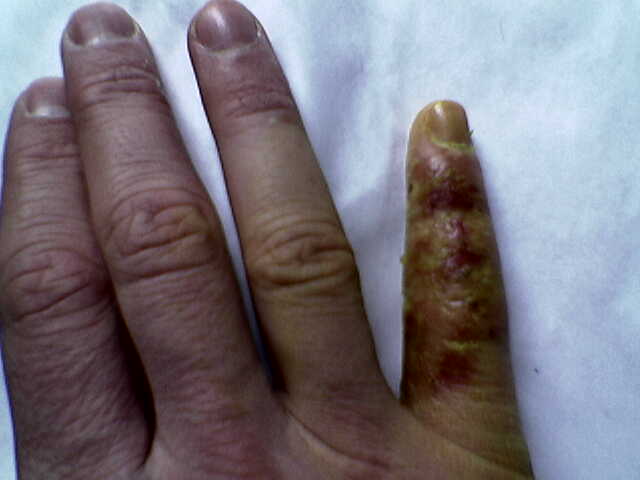 Entzündeter kleiner Finger, rechts.